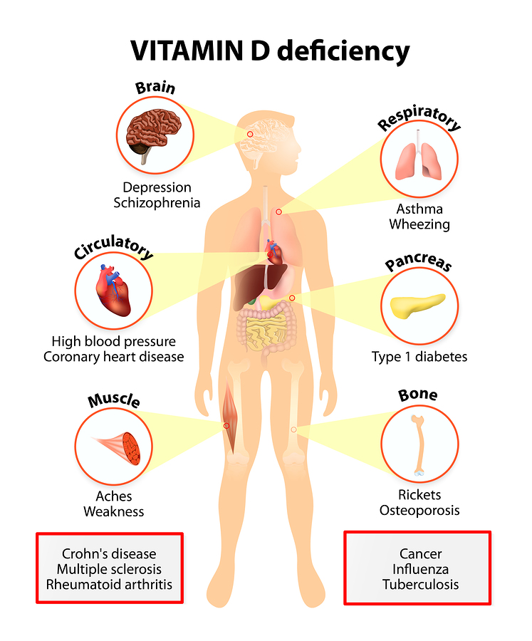 Vitamin D deficiency symptoms and diseases 