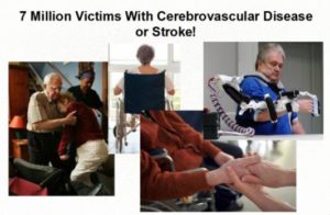 Stroke Prevention