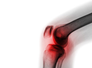 Natural Treatment for Osteoarthritis