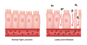 L-glutamine and Leaky Gut