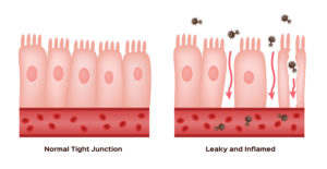 L-glutamine and Leaky Gut