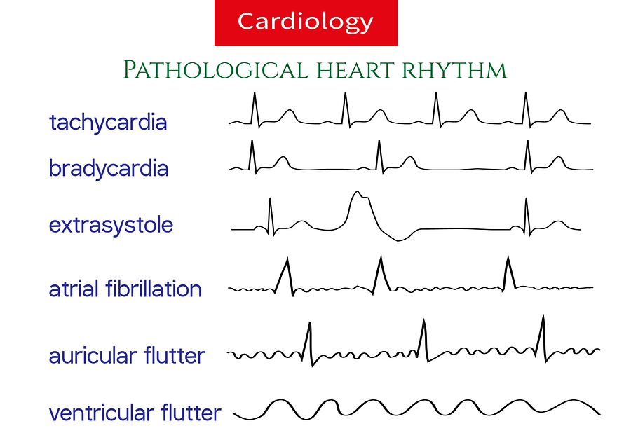 Naturally Eliminate Heart Arrhythmia