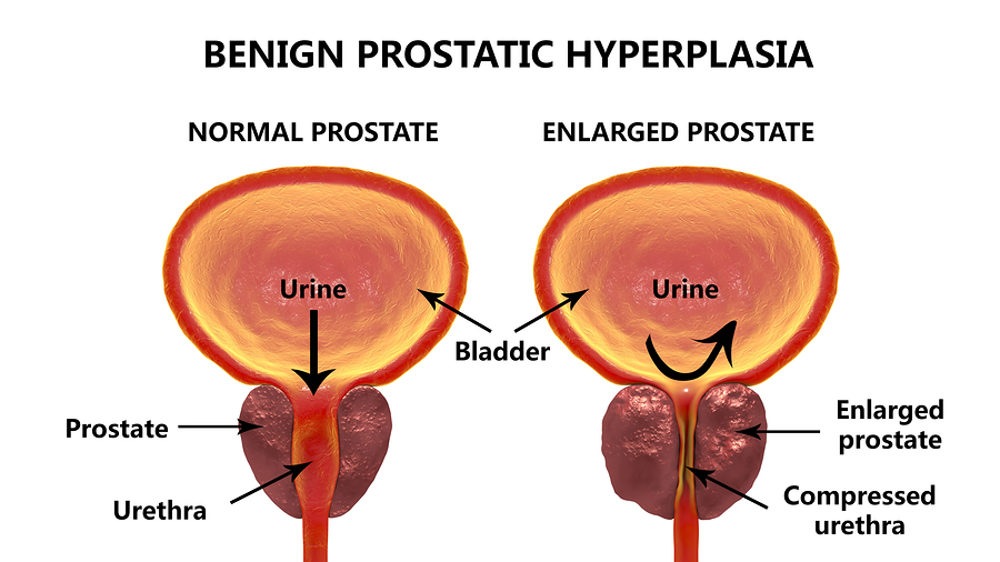 6 Key Ingredients for Prostate Health