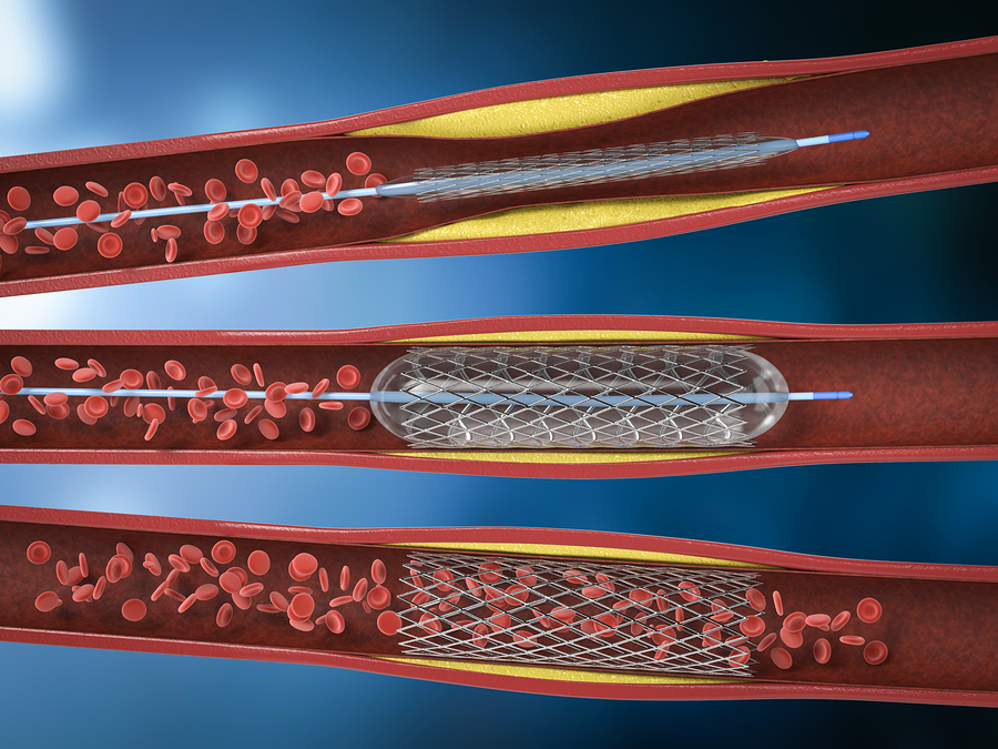 To Stent or Not To Stent