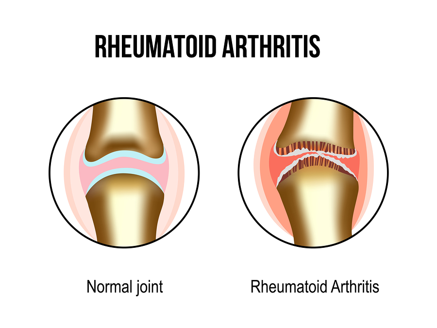 Natural Remedies for Rheumatoid Arthritis